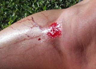 skinned knee